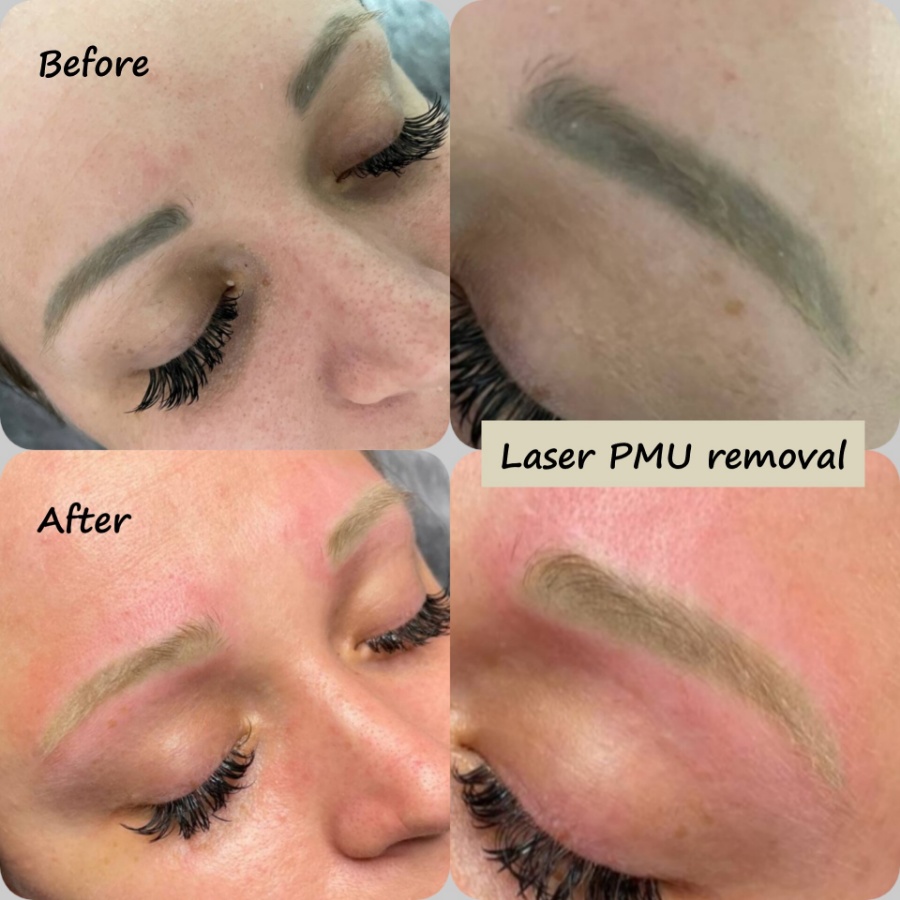 Hair-Strokes, Powder Brow, Laser tattoo/PMU removal, Correction of pmu Brows made by other master.