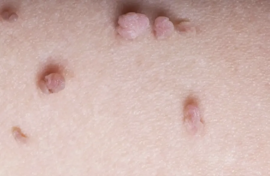 Skin tag removals