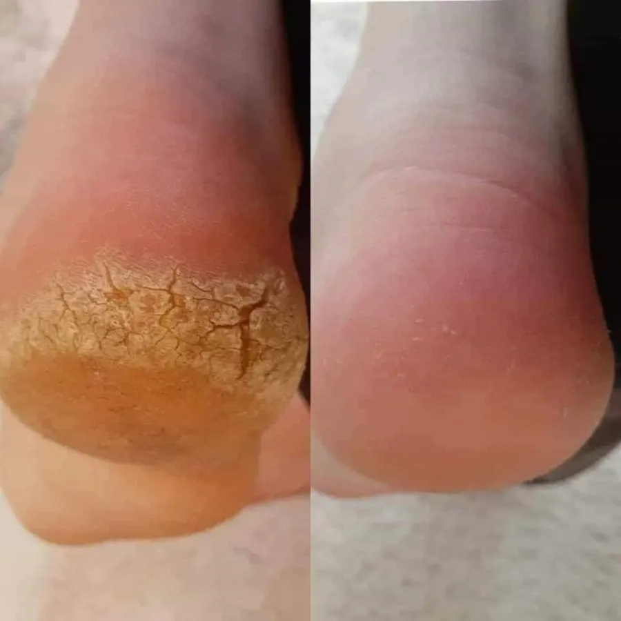 Педикюр, подологический уход  стоп с выездом к клиенту!